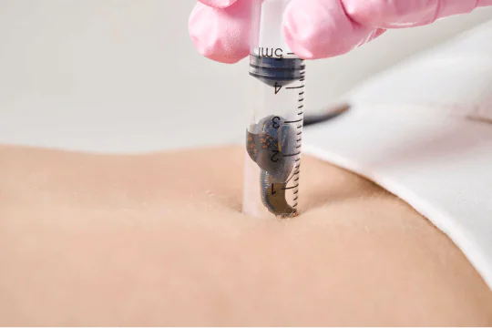 Гирудотерапия в санатории Евромед